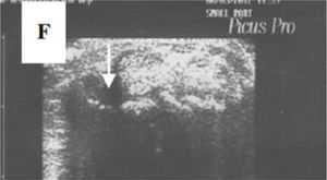 A transverse ultrasonographic view of the common extensor tendon at the level of the wrist showing by grayscale tenosynovitis in the form of effusion (arrow). Adapted (with permission) from: Abdel-Magied et al.75