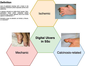 Definition and etiology of digital ulcers in systemic sclerosis.