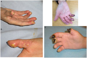 Examples of digital ulcers in systemic sclerosis, Panels A and B illustrate calcinosis-related ulcers. Panels C and D show ischemic ulcers.