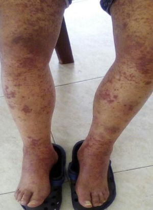 Confluent pruritic purpuric lesions of the lower extremities.