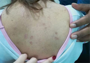 Discoid lupus in the back. Plaque-like scaly lesions over the body, remnants of blisters, compatible with chronic cutaneous lupus.