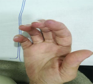 Lupus perniosis. Plaque-like, purplish lesions in the pulps of the fingers of the right hand.