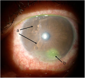 Left eye. a) nasal corneal melt. b) inferior ulcer with fluorescein stain uptake.