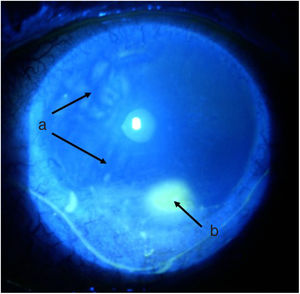 Left eye fluorescein stain and visualization under cobalt blue light. a) nasal corneal melt, negative staining by pooling of fluorescein in irregular areas of the corneal surface. b) Stain uptake of inferior ulcer.
