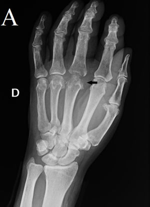 Plain PA x-ray of Dieterich’s disease; third right hand metacarpal.