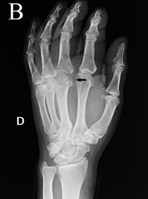 Plain oblique X-ray of Dieterich’s disease; third right hand metacarpal.