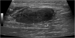 Ultrasound image of the posterior margin of the calf, with a solid nodule with well-defined margins (marked between calipers), of heterogeneous structure, mostly hypoechoic, with no cystic areas or peritumoral edema, localized between the muscle belly of the flexor digitorum longus (FLP) and the soleus (SO).