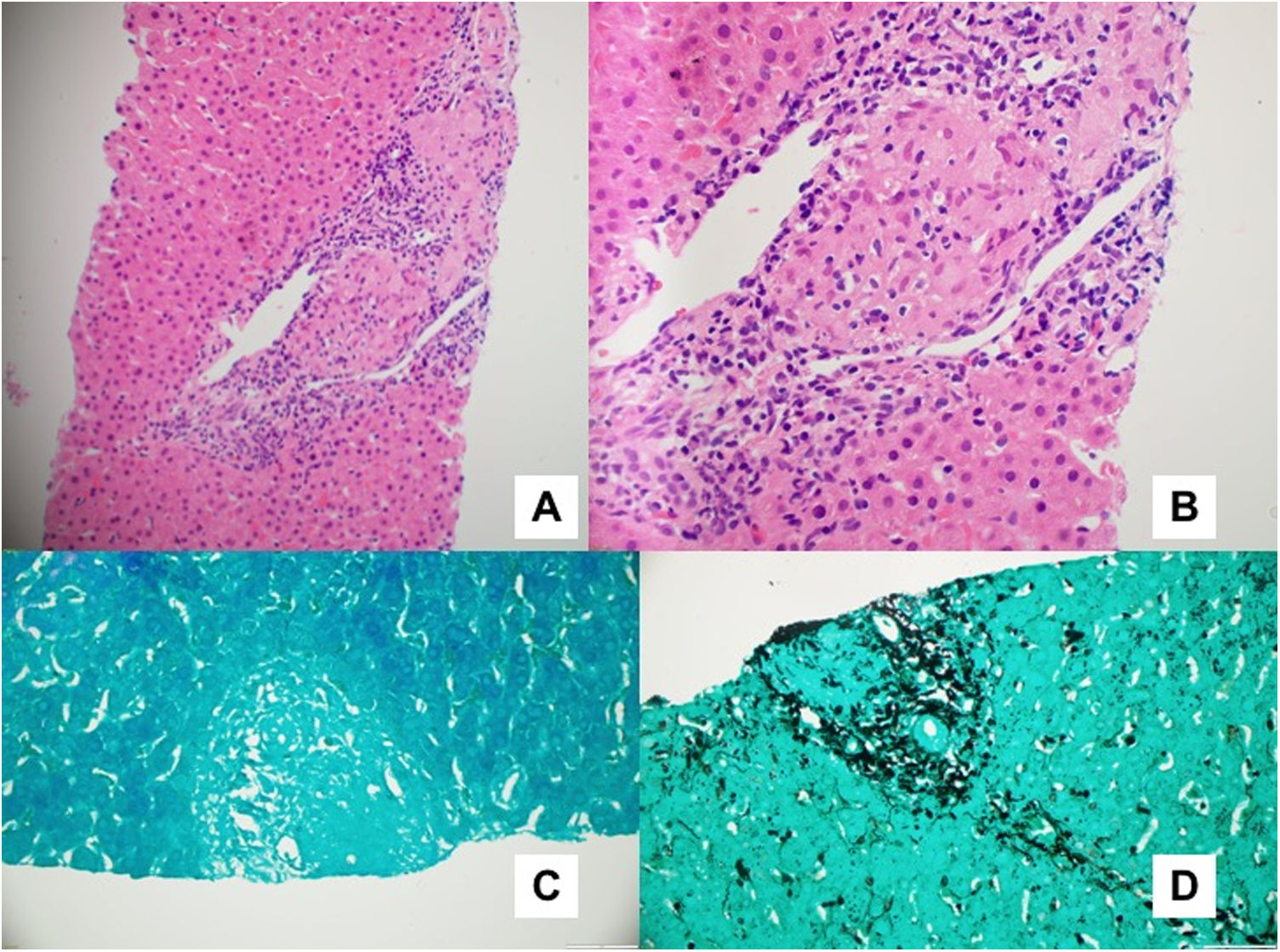 Noncaseating Noncaseating granuloma as the first manifestation of rheumatoid ...