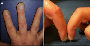 (A) Increase in volume of the distal phalanx. (B) Loss of the ungual window (Schamroth’s sign).