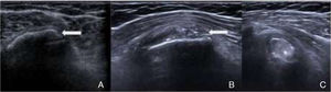 (A) Ultrasound scan taken 2 years ago. Arrow: calcification in the subscapularis near the insertion of the tendon; (B) Ultrasound taken in the acute moment. Arrow: the same location as in A, with some residual millimetric calcifications; (C) ultrasound in the acute moment. Asterisk: intramuscular coarse calcification, calcium in Fig. 2 images A–D.