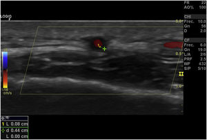 Halo sign in Doppler ultrasound.