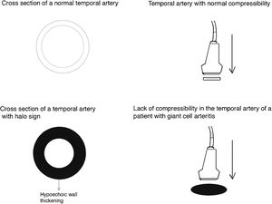 Compressibility and halo in the temporal artery.