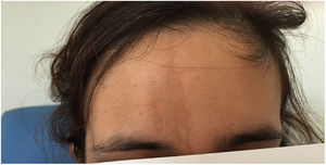 Image with hyperpigmented lesion in the right hemiforehead corresponding to scleroderma in “coup de sabre”.