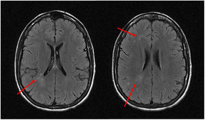 Image of the nuclear resonance imaging (MRI) in FLAIR sequence in axial plane: focal hyperintensities in subcortical and periventricular white matter of the right frontal and parietal lobes (arrows).