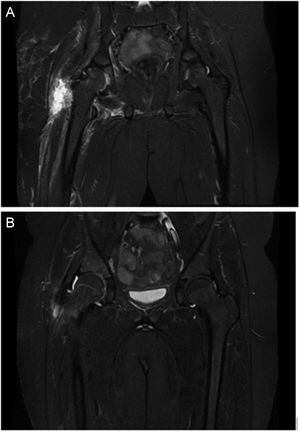 A) Acetabular osteomyelitis and myositis of the external obturator muscle and adductor muscles. B) Significant improvement in acetabular bone edema. Important decrease in muscle edema.