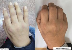 Fist before and 14 days after immunosuppressive treatment.