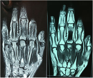 MRI of the left hand (absence of erosions in metacarpophalangeal and carpometacarpal joints, joint narrowing or bone edema).