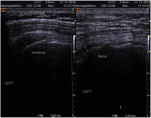 Control of the shoulder and trochanter bursitis after two weeks of immunosuppressive treatment.