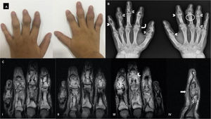A. Handsof the patient before the start of treatment. There is an increase in the thickness of the soft tissues of all the fingers with greater involvement of the middle phalanx. B. AP radiograph of both hands showing the different patterns of bone involvement in sarcoidosis: lytic pattern with localized well-defined cystic defects, accompanied by nodular soft tissue lesions (solid arrowheads); permeative pattern with enlargement of the nutrient canal of the phalanx (circles); destructive pattern that can generate scalloped or punched out lesions (empty arrowheads); honeycomb pattern with diffuse trabecular alteration (curved arrows); C. Non-contrasted nuclear magnetic resonance. (I) and (II) right hand, coronal section STIR sequence: extensive involvement of the proximal and middle phalanges by conglomerates of hyperintense intramedullary masses (corresponding to non-caseating granulomas), with cortical destruction and infiltration of adjacent soft tissues. Mild soft tissue edema is seen. (III) Left hand coronal section STIR sequence: in the middle phalanx of the third finger (solid arrowhead) fine hypointense lines perpendicular to the destroyed bone cortex (also called "ghost cortex") are observed, corresponding to the periosteal extension of granulomas; it should not be confused with periosteal reaction. Note the absence of intra-articular and distal phalangeal involvement, as well as the preserved joint relations. (IV) Sagittal T2-weighted image of the fifth finger of the right hand: increased signal intensity of the flexor tendon (empty arrow) and encapsulation therein by granulomatous infiltration (solid arrow).