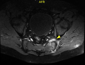 MRI of the lumbar spine with inflammatory changes in the left sacroiliac joint and in the adjacent fat.