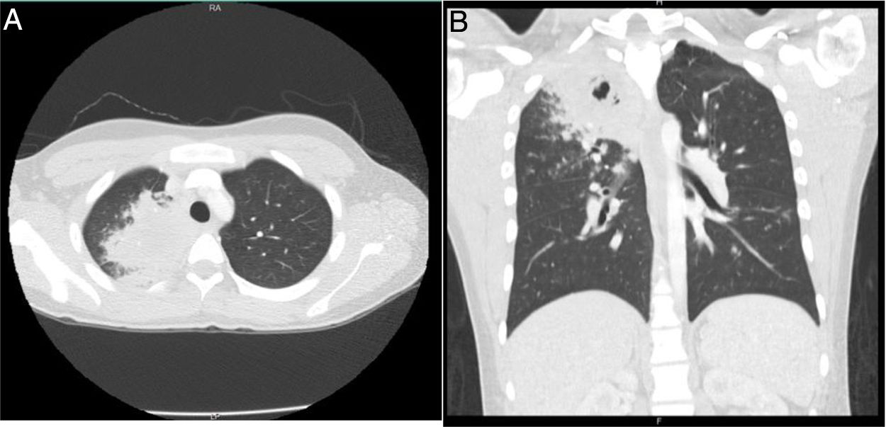 Granulomatosis with polyangiitis: A case report of early systemic ...
