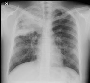 Chest X-ray, PA projection: signs of pulmonary consolidation involving the entire right apex.