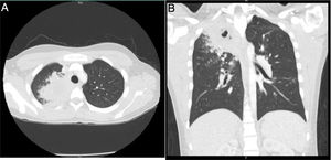 Chest tomography A) axial section. B) Coronal section. Parenchymal opacity in the apical segment of the right upper lobe, with areas suggestive of cavitation with micronodular images, which configure a "tree-in-bud".