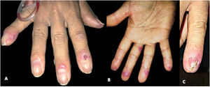 (A and B) In the proximal and lateral nail folds, fingertips, and palmar aspect of the left hand, erythematous-violaceous plaques with poorly defined irregular borders are observed. (C) In the fifth nail of the left hand, on the proximal nail fold, an erythematous-violaceous plaque, with nail dystrophy of 100% of the nail plate, distal onycholysis, and splinter hemorrhages are evidenced.