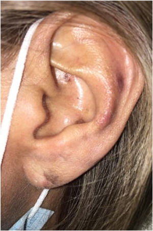 In the left ear lobe, a slightly indurated erythematous-violaceous nodule was noted. In the triangular fossa and antihelix erythematous-violaceous plaques with poorly defined irregular borders; some hematic crusts are noticed.