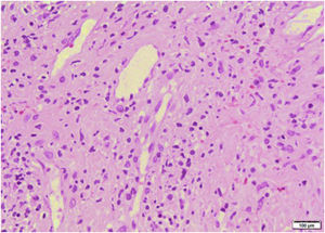 Skin biopsy on the palm: Superficial dermis with edema, telangiectasias, and extravasation of erythrocytes. Perivascular lymphoid infiltrates were identified with lymphocytes permeating the vessel wall, endothelial reactivity, and absence of necrosis. Hematoxylin-eosin staining.