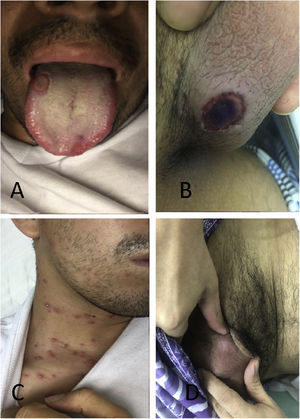 Lesions of the patient. A) Surface of the tongue with a rounded well-defined lesion covered by a yellowish pseudomembrane. B) Rounded ulcer with well-defined borders and a necrotic center, at the base of the penis. C) Pustular vesicles with erythematous halo, in the anterior thorax. D) Cicatricial lesion in the testicle after treatment.