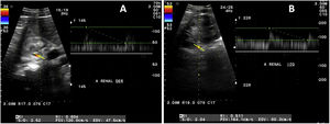 Doppler ultrasound of renal arteries. A) Right: maximum systolic velocity of 120cm/s at the ostium level and 120cm/s at the hilum, with a resistance index of 0.60. B) Left: maximum systolic velocity of 137cm/s at the ostium and 164cm/s at the hilum, with a resistance index of 0.51.