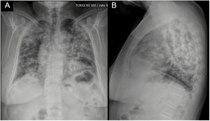 Chest X-ray: posteroanterior (A) and lateral (B) views with the presence of alveolar opacities involving 4 quadrants.
