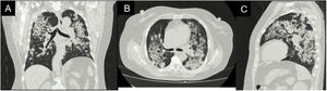 High-resolution chest tomography: coronal (A), axial (B), and sagittal (C) projections. Central airway wall thickening and consolidation areas with broncocentric distribution in both lungs, some associated with ground-glass areas.