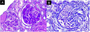 Renal biopsy. A. Acute necrotizing glomerulonephritis pattern without chronicity changes. B. Presence of cell crescents, mononuclear infiltrate in the interstitium, active tubular damage, and tubular atrophy with fibrinoid necrosis.