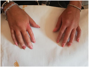 the hands of the patients, characterized by puffy fingers and sclerodactyly, with thickening of the skin of the fingers of both hands up to the metacarpophalangeal joints.