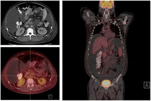 Positron emission tomography with evidence of hypermetabolism in supra and infra diaphragmatic nodes, with abdominal lymph node conglomerate. On the left, location of supraclavicular node.