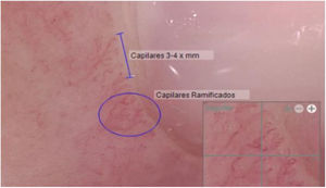 Capillaroscopy findings two years after treatment: Capillary density 3–4×mm, Neoangiogenic capillaries +, Giant capillaries: No, Capillary dilations: No, Hemorrhages: No.