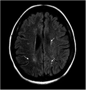 FLAIR sequence MRI showing focal paraventricular and corticosubcortical lesions (arrows).