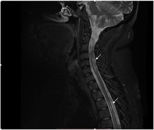 T2 sequence MRI showing hyperintense focal images at the level of the spinal cord located predominantly laterally with diffuse distribution in the cervical and thoracic spine (arrows).