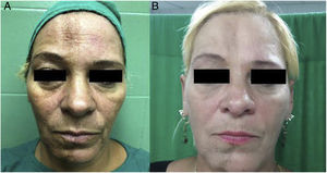Grade 2 facial lipoatrophy: front view preoperatively (A) and 3 months postoperatively (B).