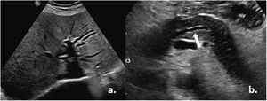 Abdominal ultrasound. a) Dilatation of the biliary tract. b) Dilatation of the Wirsung duct (white arrow). Taken from the Imaging Service of the Metropolitan Hospital.