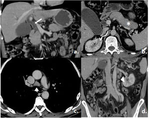 Contrast tomography of the thorax and abdomen. a) Dilatation and enhancement of the common bile duct (white arrow). b) Loss of the peripheral lobulations of the pancreas (asterisk) and multiple renal perfusion defects (curved arrow). c and d) Mediastinal and retroperitoneal adenomegalies (arrowheads). Taken from the Imaging Service of the Metropolitan Hospital.