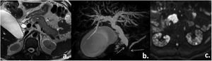 Abdominal MRI. a) T2 axial slice: alteration of pancreatic morphology (short arrows). b) Volumetric reconstruction of the biliary tract: filiform narrowing of the common bile duct and the Wirsung duct with proximal dilatation (long arrows). C) Axial slice in diffusion: patchy alteration of the renal signal (asterisk). Taken from the Imaging Service of the Metropolitan Hospital.