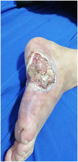 Large deep ulcer on the lateral aspect of the right foot, with exposure of muscle and tendon tissue, with irregular and macerated edges, surrounded by reticulated purpuric macules.