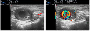 Anechoic mass with thickened walls, positive power-Doppler signal. Enlarged median nerve, maximum diameter: 58 mm (arrow).
