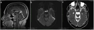 A) Intrasellar lesion with suprasellar extension. B) Hypovascular behavior after the application of intravenous contrast. C) The infundibulum and the pituitary gland are displaced posteriorly, exerting an extrinsic compressive effect on the optochiasmatic pathway.