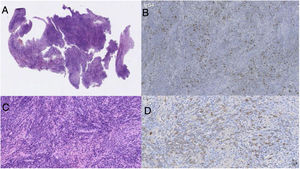 A and C) H&E staining. Pituitary gland with abundant lymphoplasmacytic infiltrate within the collagenous stroma, with sclerotic foci. B and D) Immunohistochemical technique. Increased IgG4:IgG ratio of 60%.