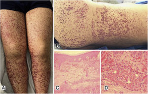 A, B) Multiple purpuric macules and papules that do not disappear on digital pressure in the lower limbs, buttocks and posterior trunk, some with hematic crust on their surface. C) Skin biopsy with evidence of leukocytoclastic vasculitis and fibrinoid necrosis in superficial and deep dermal vessels. H&E 10×. D) Extravasation of erythrocytes with fibrinoid necrosis of small dermal vessels. H&E 40×.