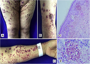 A, B, C) Multiple purpuric macular plaques and blisters with hemorrhagic content located on the lower and upper limbs, scarce pustules. D) Skin biopsy with perivascular polymorphonuclear inflammatory infiltrate, intraepidermal erythrocyte extravasation and scarce fibrinoid necrosis of superficial dermal vessels. H&E 10×. E) Extravasation of erythrocytes. H&E 40×.